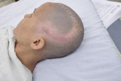  Hình ảnh bệnh nhân sau phẫu thuật. Ảnh: BVCC. 