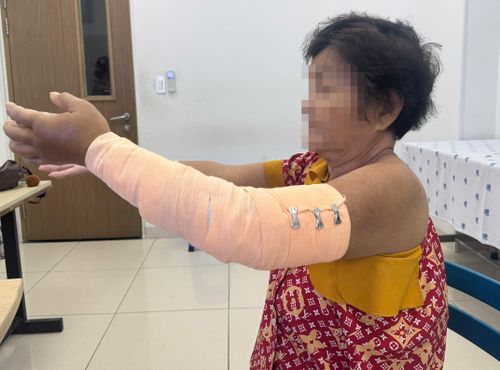Người phụ nữ gãy xương phức tạp sau một cú ngã. Ảnh: BVCC.