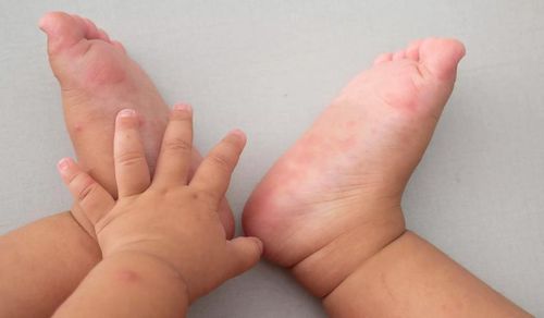 Trẻ mắc bệnh tay chân miệng cần được theo dõi sát sao, tránh các biến chứng nặng. Ảnh: IT