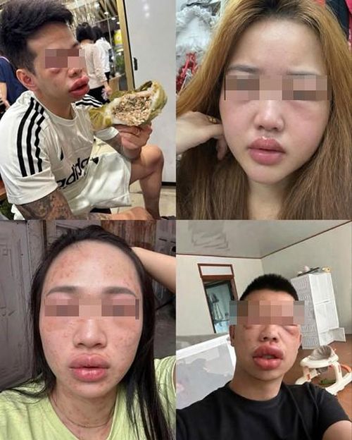 Mặc dù trứng kiến là món ăn đặc sản với hương vị độc đáo tại vùng núi phía Bắc được yêu thích, nhưng không ít người lại bị dị ứng trứng kiến sau khi thưởng thức món ăn này.