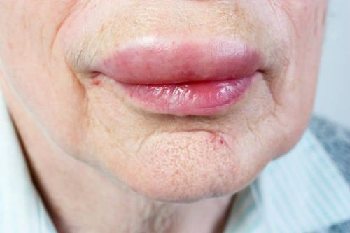 Hình ảnh sưng môi, miệng do dị ứng thực phẩm.