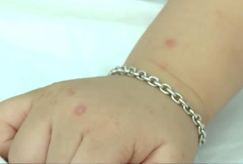 Ca mắc tay chân miệng chủ yếu xảy ra ở nhóm trẻ từ 1 đến 5 tuổi đang học tại các cơ sở mầm non, mẫu giáo.