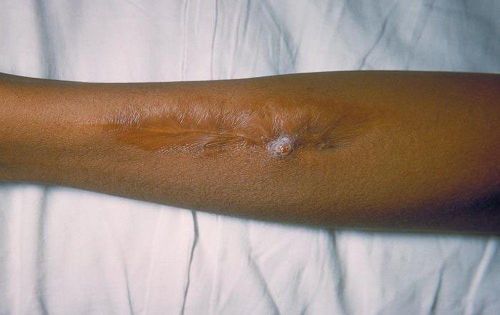 Tổn thương trên da do vi khuẩn Salmonella. Ảnh: CDC Mỹ.