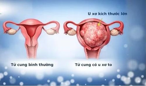 U xơ tử cung kích thước lớn - Ảnh BVCC