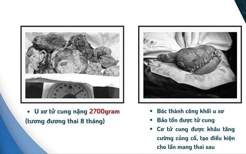 Khối u nặng 2700g đã được bóc tách thành công - Ảnh BVCC