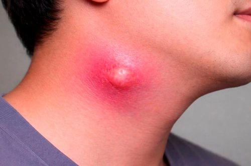 Từ đau họng, viêm amidan, bệnh có thể tiến triển thành áp xe cổ nguy hiểm. Ảnh: Freepik.