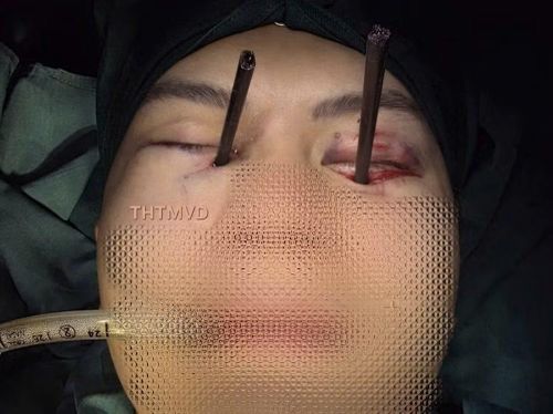 Nam thanh niên bị 2 chiếc đũa đâm sâu vào 2 mắt. (Ảnh: PV/Vietnam+)
