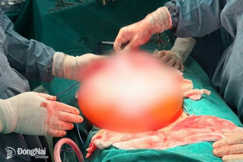 Khối u buồng trứng “khổng lồ” được các bác sĩ bóc tách ra khỏi cơ thể bệnh nhân. Ảnh: H.Chất
