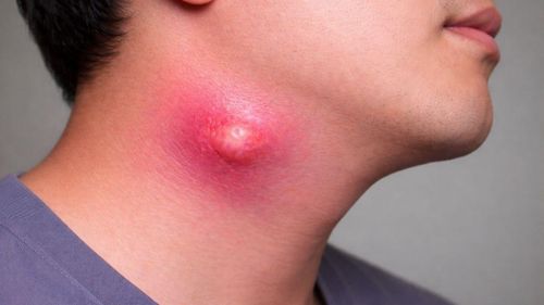 Bệnh áp xe cổ có thể diễn biến nhanh, gây nhiều biến chứng nghiêm trọng, thậm chí đe dọa tính mạng nếu không được phát hiện và điều trị kịp thời. Ảnh minh họa