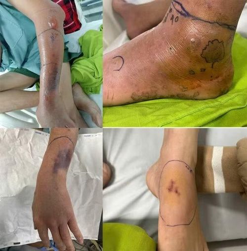 Hình ảnh một số vết thương do rắn cắn của người bệnh khi nhập viện tại Bệnh viện Đa khoa tỉnh Phú Thọ - Ảnh BVCC
