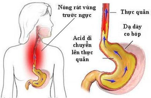 Biểu hiện của bệnh trào ngược dạ dày - thực quản.
