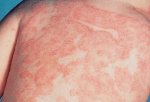 Một phản ứng nghiêm trọng hiếm gặp khi sử dụng thuốc idvynso là Hội chứng Stevens-Johnson