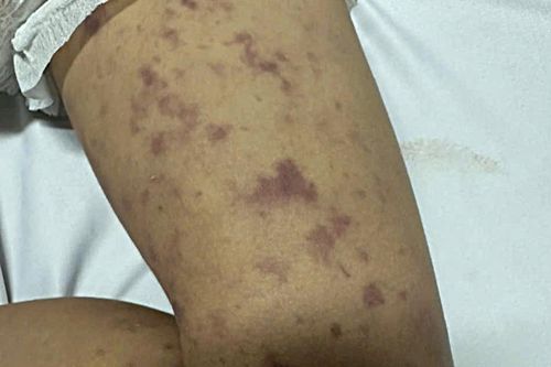  Bệnh nhi mắc viêm não mô cầu xúat hiện những nốt tử ban trên da khắp cơ thể. Ảnh: CDC Đắk Lắk. 
