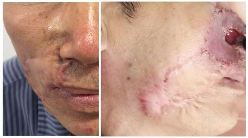 Hình ảnh trước và sau của bệnh nhân sau điều trị Ung thư biểu mô tế bào đáy (BCC)