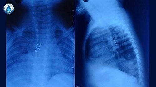 Hình ảnh dị vật nằm sâu trong phế quản. Ảnh: BVCC