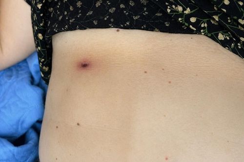 Vết loét nghi do sốt mò trên cơ thể người bệnh. Ảnh: Trung tâm Y tế khu vực Hạ Hòa.