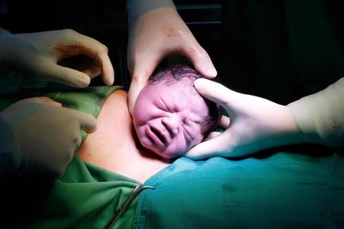 Sinh mổ là một cuộc phẫu thuật lớn, trong đó bác sĩ rạch thành bụng và tử cung để đưa em bé ra ngoài. Ảnh: Bệnh viện Phụ sản Hà Nội.