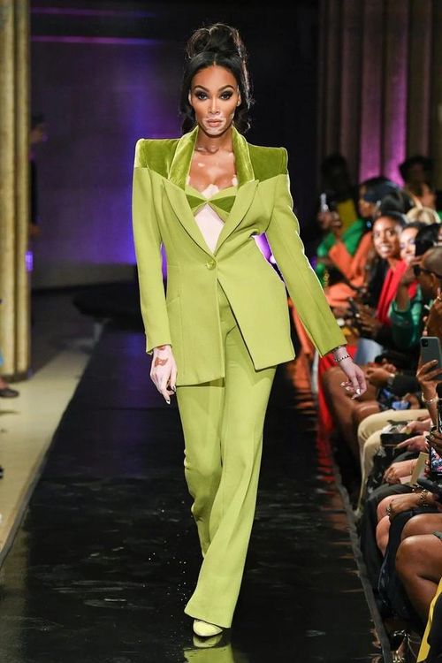 Winnie Harlow, một trong những người mẫu bạch biến hiếm hoi trên thế giới. Ảnh: Iker Aldama/INDIGITAL.