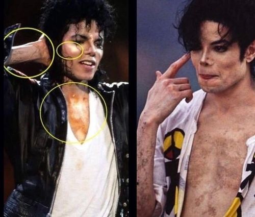 Làn da trở nên loang lổ khiến Michael Jackson trở nên mặc cảm, buộc ông phải tìm cách làm đều màu da để giảm bớt sự chú ý không đáng có vào những khiếm khuyết ngoại hình. Ảnh: Spike Lee, Facebook