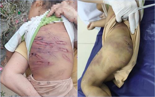 Hình ảnh cháu bé N.G.K - con của Nguyễn Thị Thanh Trúc bị bạo hành thương tích. Ảnh: CATPHCM
