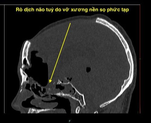 Hình ảnh X-quang cho thấy lỗ rò dịch não tủy do vỡ xương nền sọ.