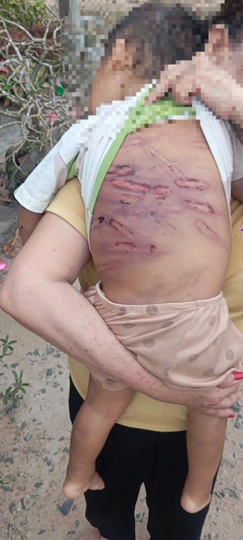 Những vết thương trên người bé K. do bị bạo hành