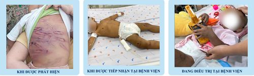 Tình trạng của bé N.G.K. trước và sau khi điều trị.