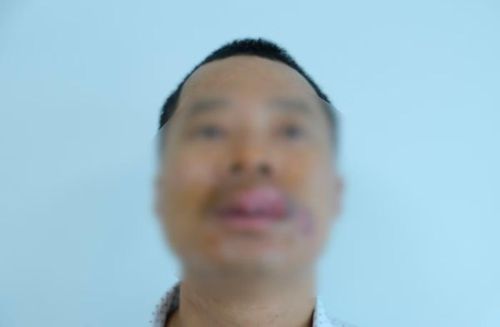 Tổn thương môi do cắn - Ảnh BVCC