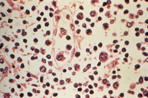 Mẫu bệnh phẩm của một bệnh nhân nhiễm virus Hanta. Ảnh: Reuters/TTXVN