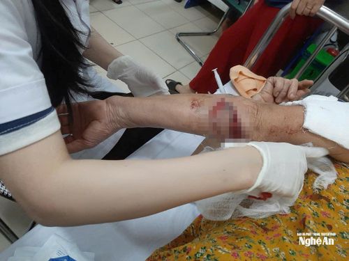 Người dân phải nhập viện xử lý vết thương sau khi bị chó dữ tấn công. Ảnh: CSCC