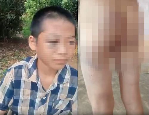 Cháu Th. với nhiều vết bầm tím ở mắt, tay chân, mông nghi bị người thân bạo hành.