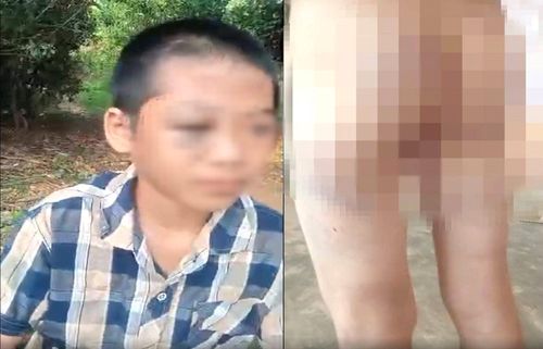 Nhiều vết bầm tím ở mắt, tay, chân và mông xuất hiện trên cơ thể cháu Th., nghi do bị người thân bạo hành.
