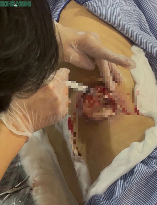 Tiếp đến, tiêm một chất gì đó xung quang vùng tổn thương của ông cụ, máu đỏ loang cả miếng bông xung quanh.