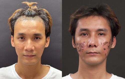 Chí Nguyện hoàn thiện với cấy tóc, trị sẹo, nâng mũi, cắt mí, cấy mỡ mặt.