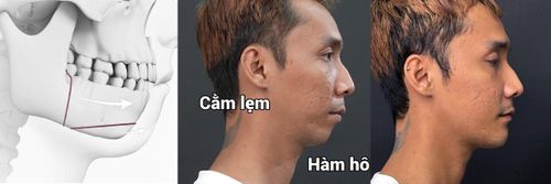 Lê Chí Nguyện sau chỉnh hàm hô & trượt cằm.