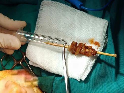 Hình ảnh dị vật được các bác sĩ phẫu thuật lấy ra. Ảnh: BVCC