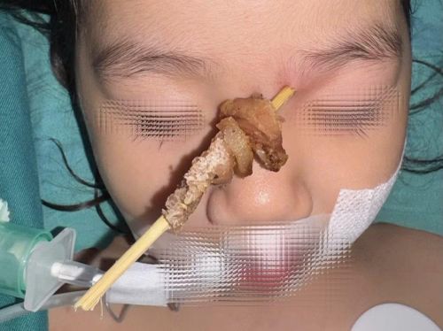 Que xiên thịt nướng cắm sâu từ vùng gốc mũi trái hướng thẳng lên hốc mắt và nền sọ.
