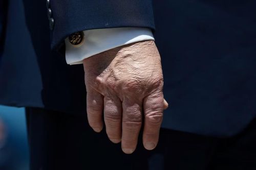 Lớp trang điểm trên mu bàn tay của Tổng thống Mỹ Trump, dường như là để che vết bầm tím. (Ảnh: Reuters)