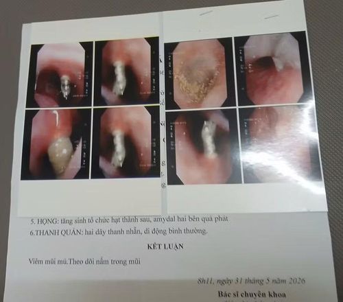 Bệnh nhân N.C.K bị 4 chiếc đinh vít nong hàm chọc thẳng lên mũi. Ảnh: NVCC.