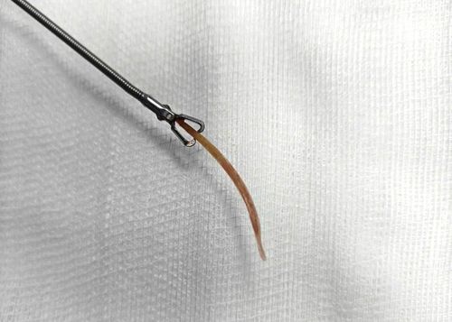 Hình ảnh dị vật là tăm tre được lấy ra khỏi đại tràng của bệnh nhân. Ảnh: BVCC.