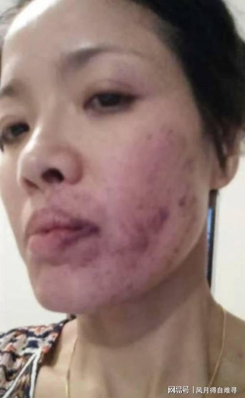 Bức ảnh diễn viên bị tát bầm mặt gây tranh cãi. Ảnh: Weibo.