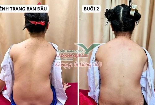 Bệnh nhân 15 tuổi sử dụng phương pháp "Khai thông cột sống" của Lão Nhà Quê