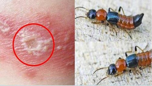 Mùa hè là thời điểm kiến ba khoang hoạt động mạnh - hiểu đúng về loại côn trùng này và biết cách xử trí kịp thời sẽ giúp mỗi người chủ động bảo vệ sức khỏe làn da của mình và gia đình. Ảnh minh họa