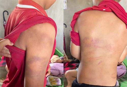 Bé trai 10 tuổi ở Nghệ An với nhiều vết thương trên cơ thể sau khi bị bố dùng roi tre đánh. Vụ việc khiến dư luận bức xúc và đặt ra nhiều trăn trở về bạo lực với trẻ em trong gia đình.