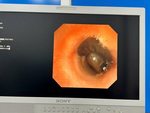 Hình ảnh nội soi phát hiện con đỉa còn sống nằm tại vị trí ngã ba khí quản