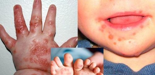 Từ đầu năm 2026 đến nay, tỉnh Lâm Đồng ghi nhận 2.265 ca mắc bệnh tay chân miệng, tăng 1.510 ca (176,6%) so với cùng kỳ năm 2025. Ảnh minh họa.