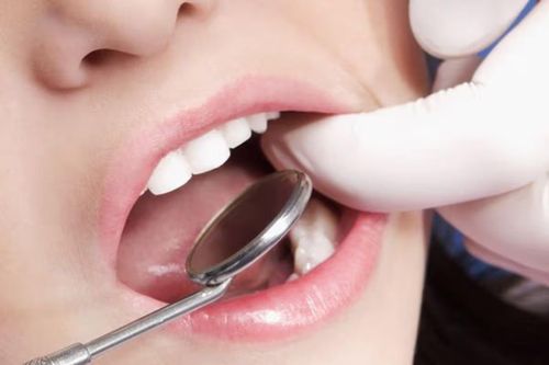 Khoảng 80-90% trường hợp hôi miệng có nguyên nhân từ chính khoang miệng. Ảnh: Shutterstock.
