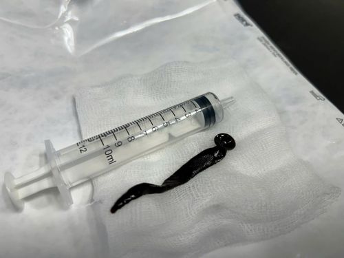 Các bác sĩ nội soi cấp cứu, lấy ra con đĩa dài hơn 12cm