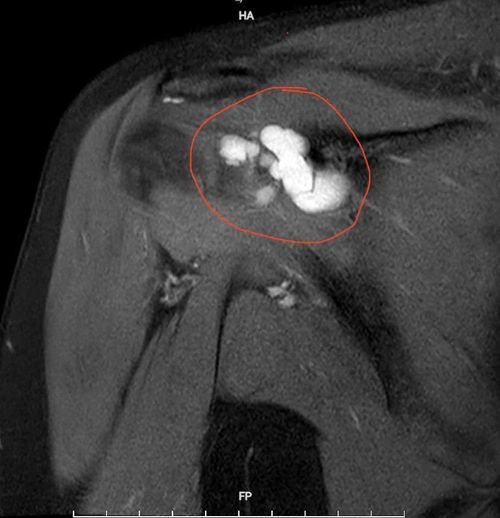 Hình ảnh chụp cộng hưởng từ (MRI) khối u kích thước khoảng 4×2 cm gây hẹp khoang mỏm cùng vai, chèn ép các cấu trúc xung quanh.