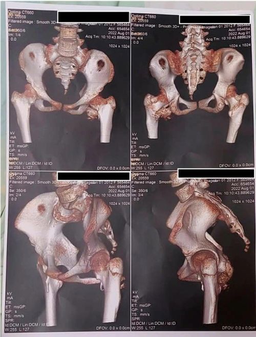 Hình ảnh 3D chụp cắt lớp vi tính vùng khung chậu của bệnh nhân cho thấy tình trạng canxi hóa mô mềm quanh khớp.
